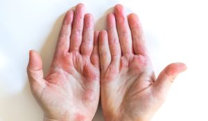 Découvrez l'alimentation à privilégier quand on souffre de l'eczéma !